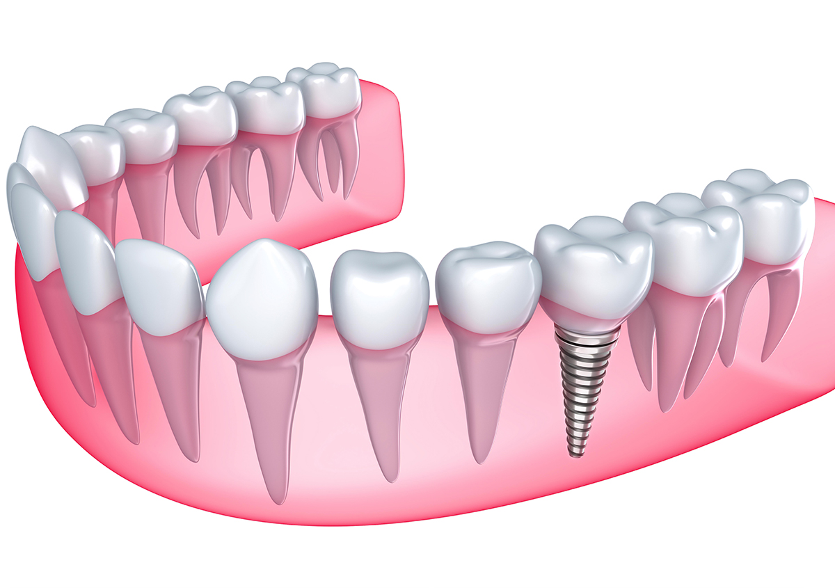 FAQ on the Implant Procedure from Your Dental Implant Dentist Office in Oakville Area