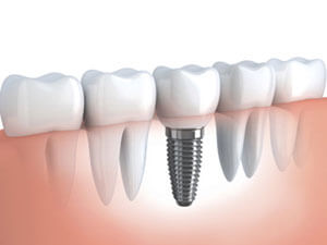 Dentist Oakville - Burloak Centre Dentistry - Dental Implants Oakville 